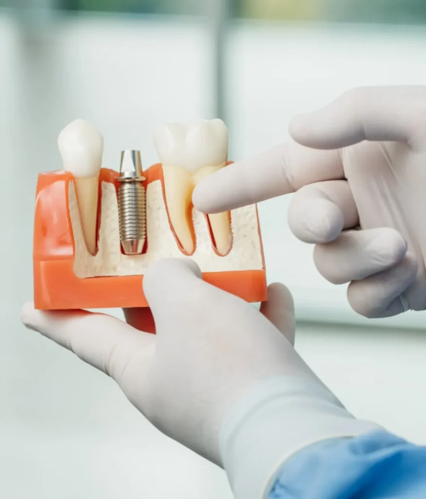 هزینه ایمپلنت دندان در ایران در سال 1404 چقدر است؟