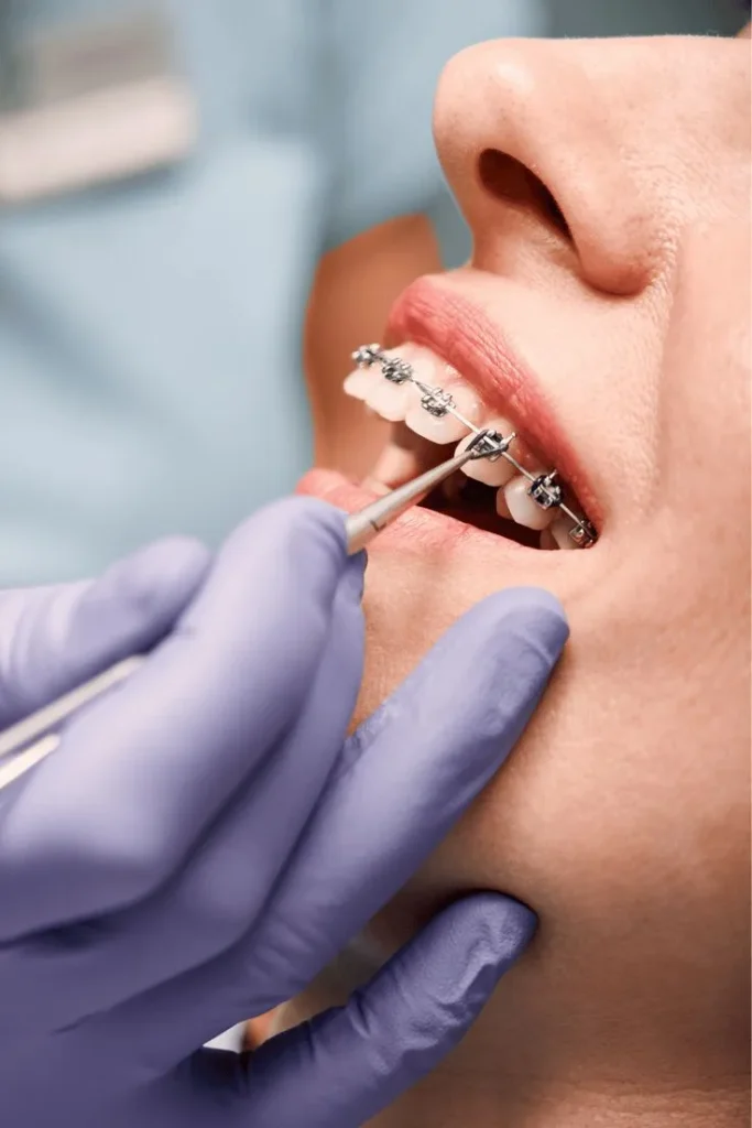 بهترین سن برای ارتودنسی دندان | راهنمای کامل 2025