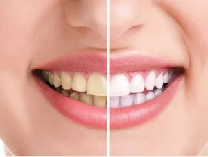 سفید کردن دندان با لیزر | راهنمای جامع 2025