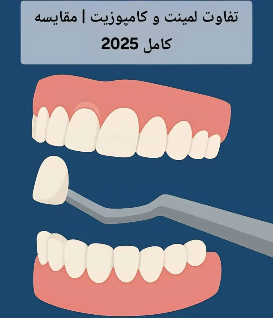 تفاوت لمینت و کامپوزیت | مقایسه کامل 2025