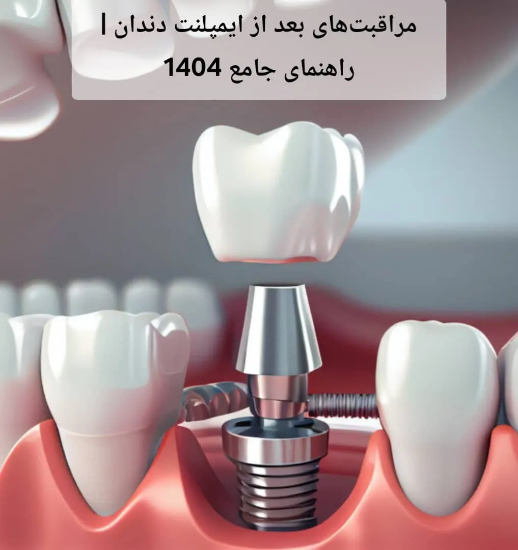 مراقبت‌های بعد از ایمپلنت دندان | راهنمای جامع 1404