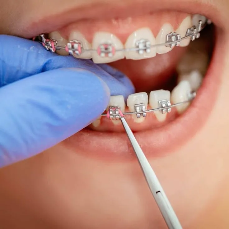 بهترین سن برای ارتودنسی دندان | راهنمای کامل 2025