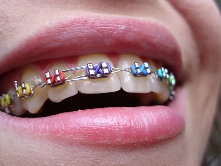 بهترین سن برای ارتودنسی دندان | راهنمای کامل 2025