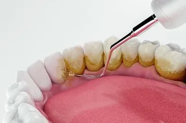 جرمگیری دندان هر چند وقت یکبار لازم است؟ راهنمای جامع 2025