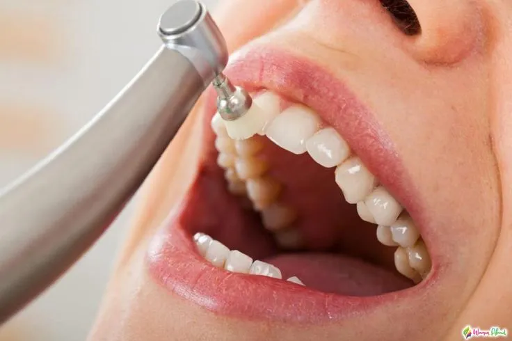 جرمگیری دندان هر چند وقت یکبار لازم است؟ راهنمای جامع 2025