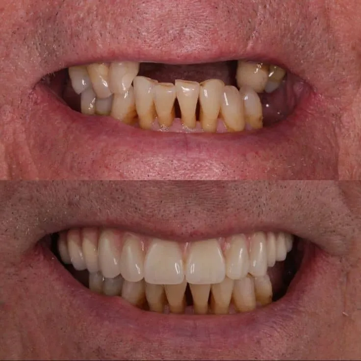 آیا ایمپلنت واقعاً دائمی است؟ بررسی علمی و کامل 2025