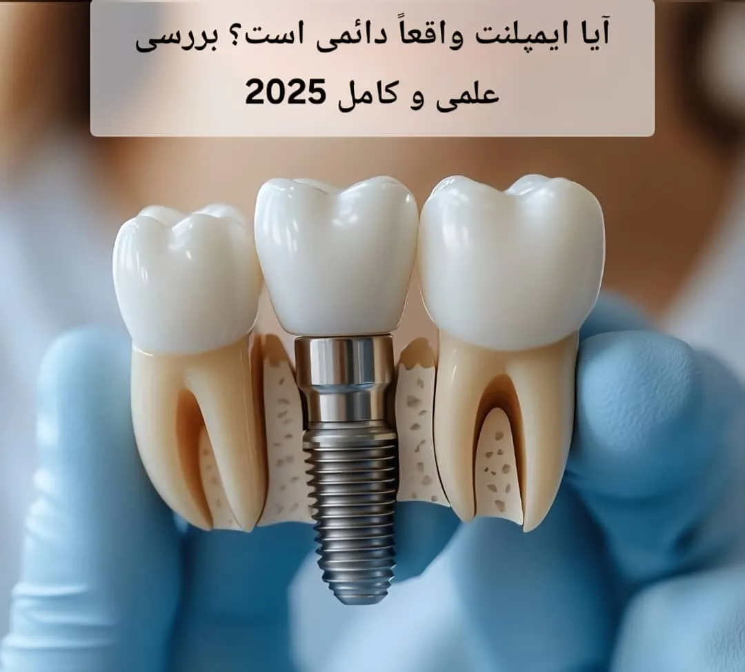 آیا ایمپلنت واقعاً دائمی است؟ بررسی علمی و کامل 2025