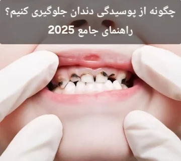 چگونه از پوسیدگی دندان جلوگیری کنیم؟ راهنمای جامع 2025