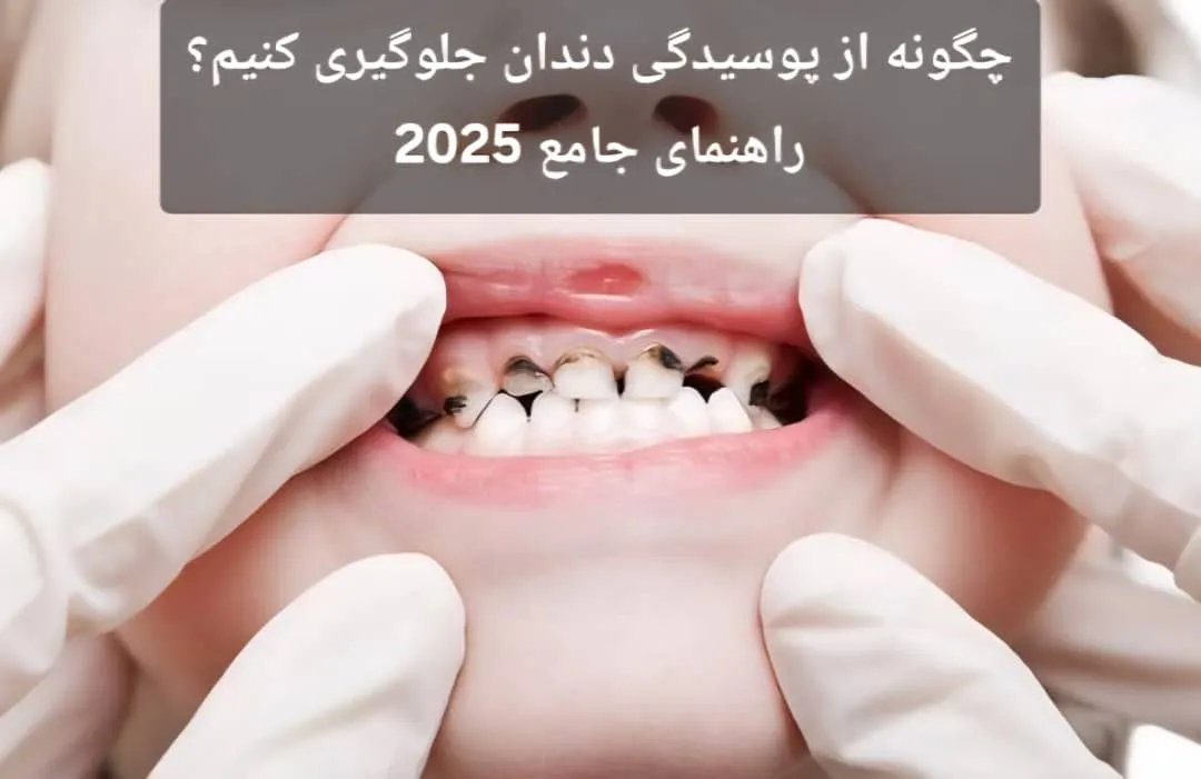 چگونه از پوسیدگی دندان جلوگیری کنیم؟ راهنمای جامع 2025