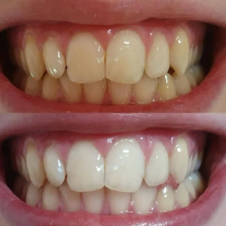 بهترین روش سفید کردن دندان در خانه | راهنمای جامع 2025