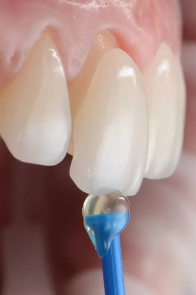 7 عوارض لمینت دندان و چگونگی پیشگیری از آنها 