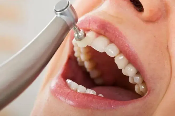 جرم گیری یا بلیچینگ: 5 نکته برای انتخاب درست