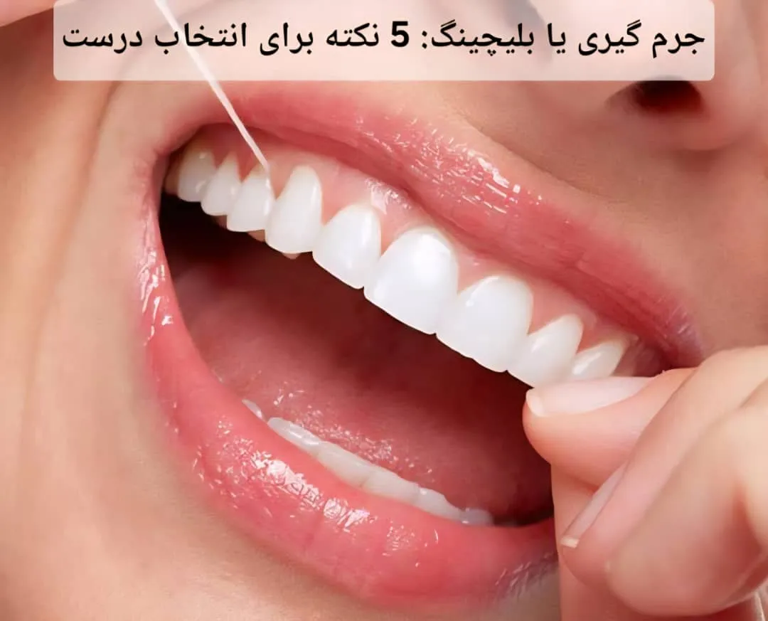 جرم گیری یا بلیچینگ: 5 نکته برای انتخاب درست