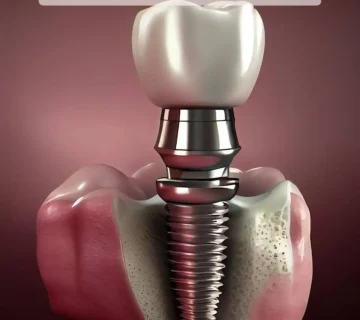 7 مزیت اصلی ایمپلنت فوری دندان
