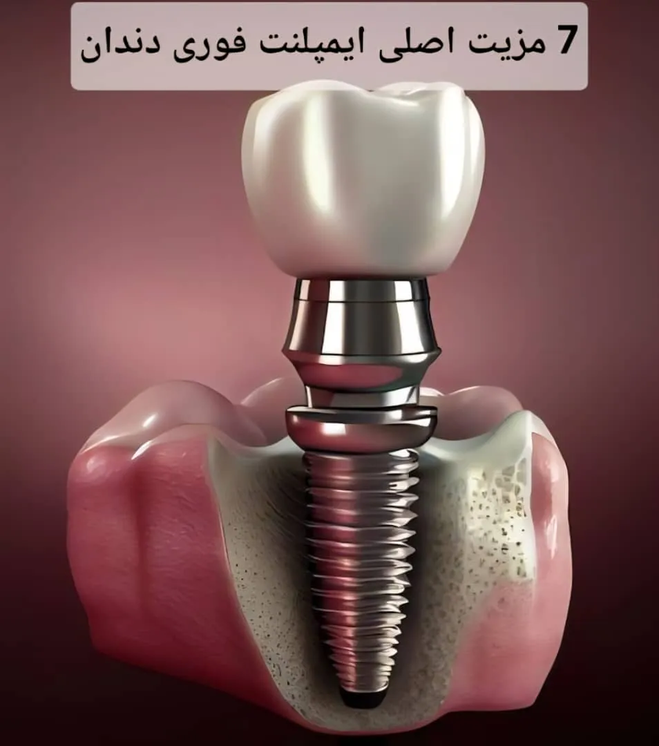 7 مزیت اصلی ایمپلنت فوری دندان
