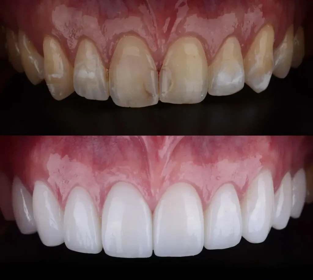 پرکردن دندان با کامپوزیت یا آمالگام | مقایسه کامل 2026