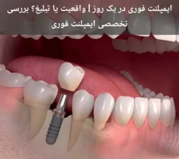 ایمپلنت فوری در یک روز | واقعیت یا تبلیغ؟ بررسی تخصصی