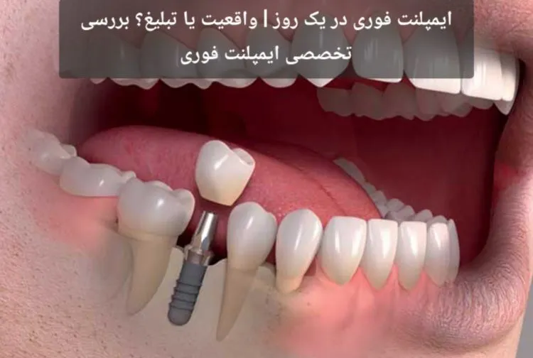 ایمپلنت فوری در یک روز | واقعیت یا تبلیغ؟ بررسی تخصصی