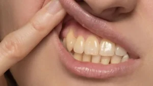 علت زرد شدن دندان ها؛ بررسی 7 دلیل اصلی که نمی‌دانستید