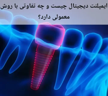 ایمپلنت دیجیتال چیست و چه تفاوتی با روش معمولی دارد؟