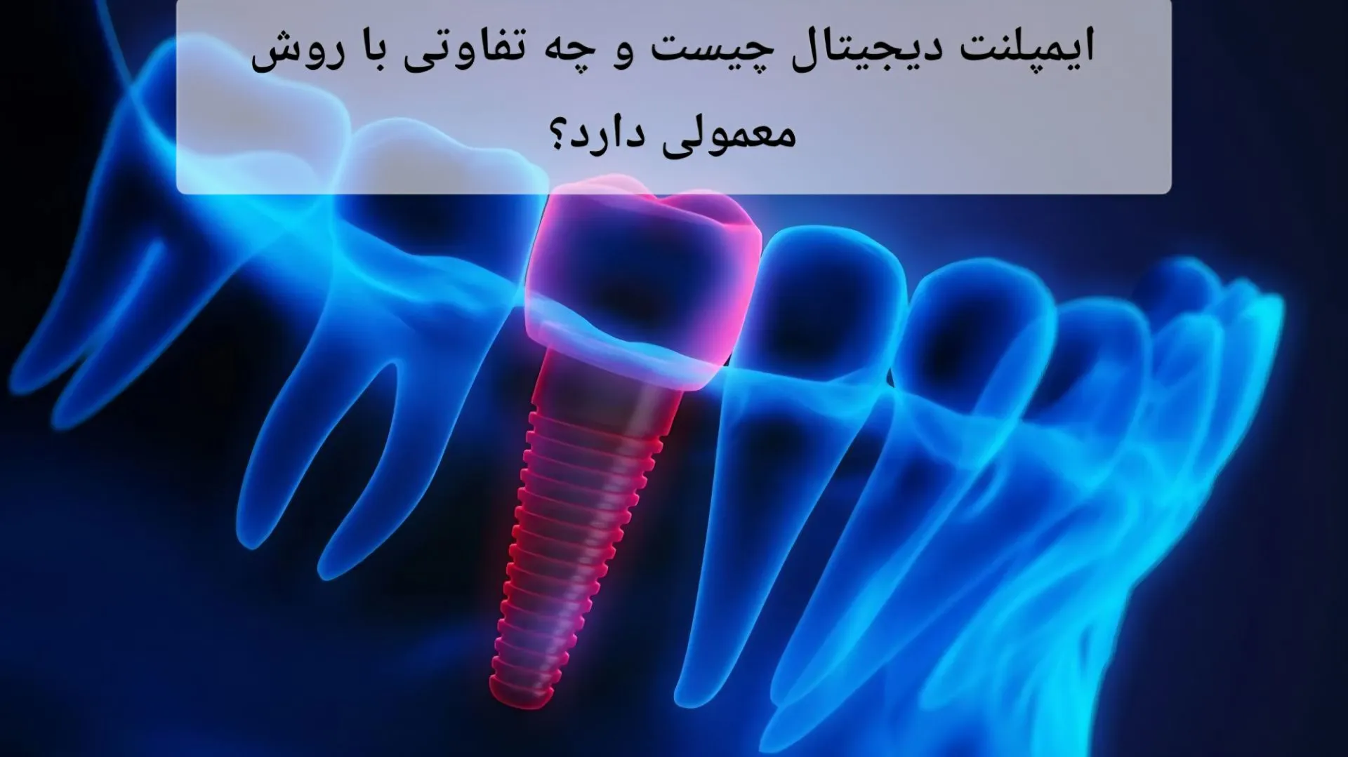 ایمپلنت دیجیتال چیست و چه تفاوتی با روش معمولی دارد؟