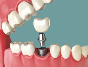 ایمپلنت فوری در یک روز | واقعیت یا تبلیغ؟ بررسی تخصصی