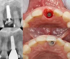 ایمپلنت فوری در یک روز | واقعیت یا تبلیغ؟ بررسی تخصصی