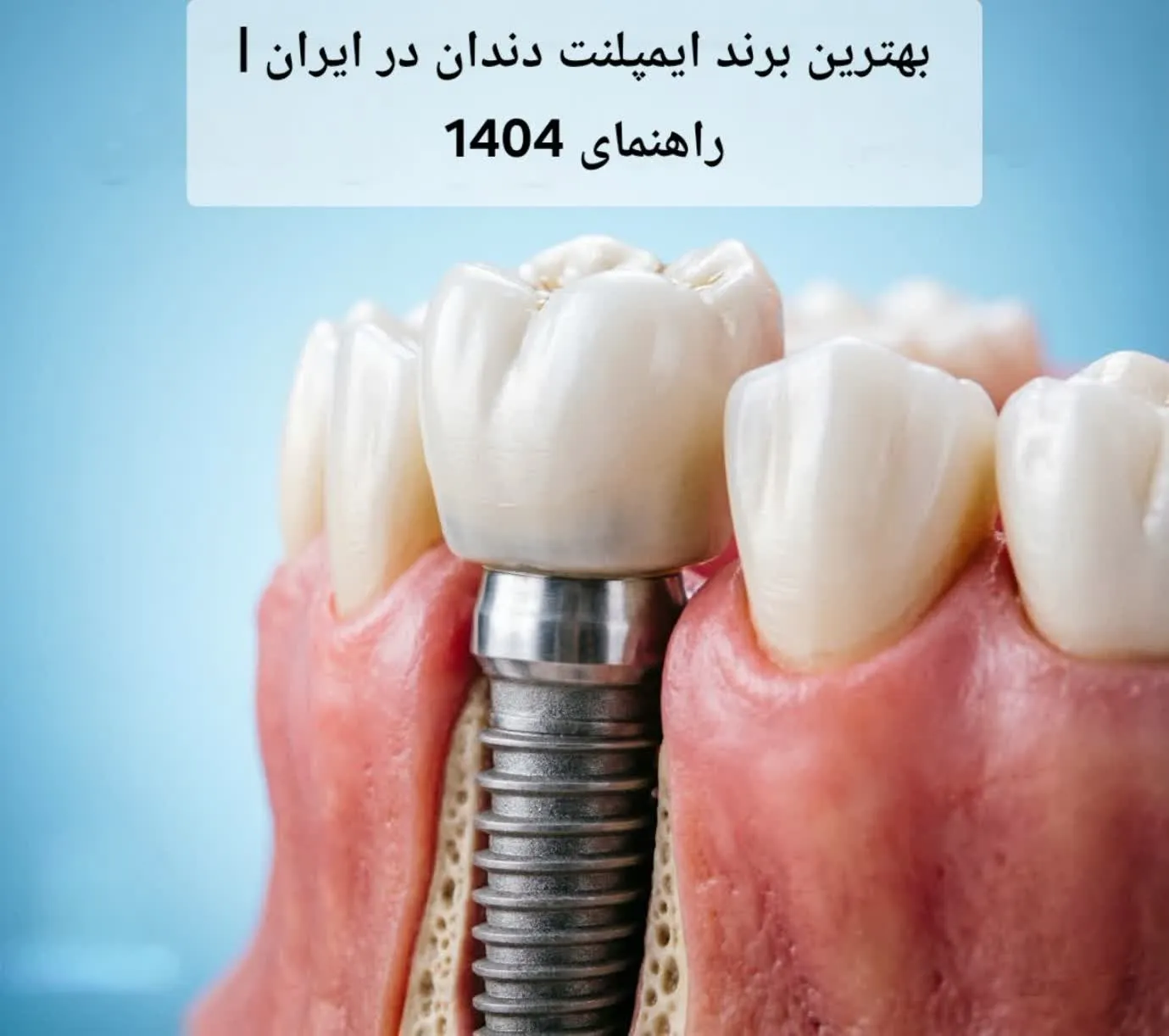 بهترین برند ایمپلنت دندان در ایران | راهنمای 1404