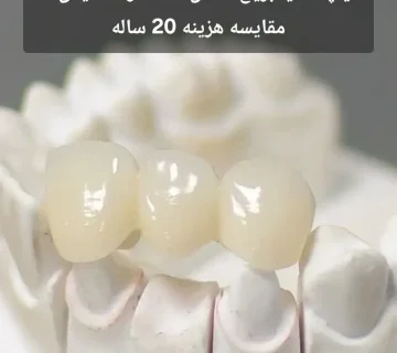 ایمپلنت یا بریج دندان؟ 6 تفاوت کلیدی + مقایسه هزینه 20 ساله