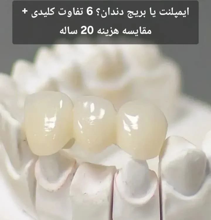 ایمپلنت یا بریج دندان؟ 6 تفاوت کلیدی + مقایسه هزینه 20 ساله