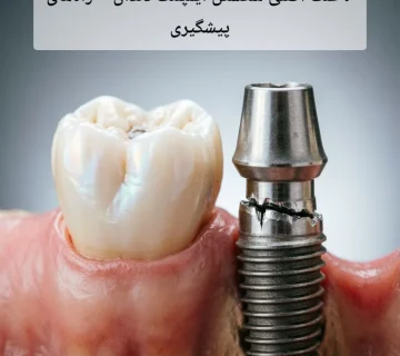 7 علت اصلی شکستن ایمپلنت دندان + راه‌های پیشگیری
