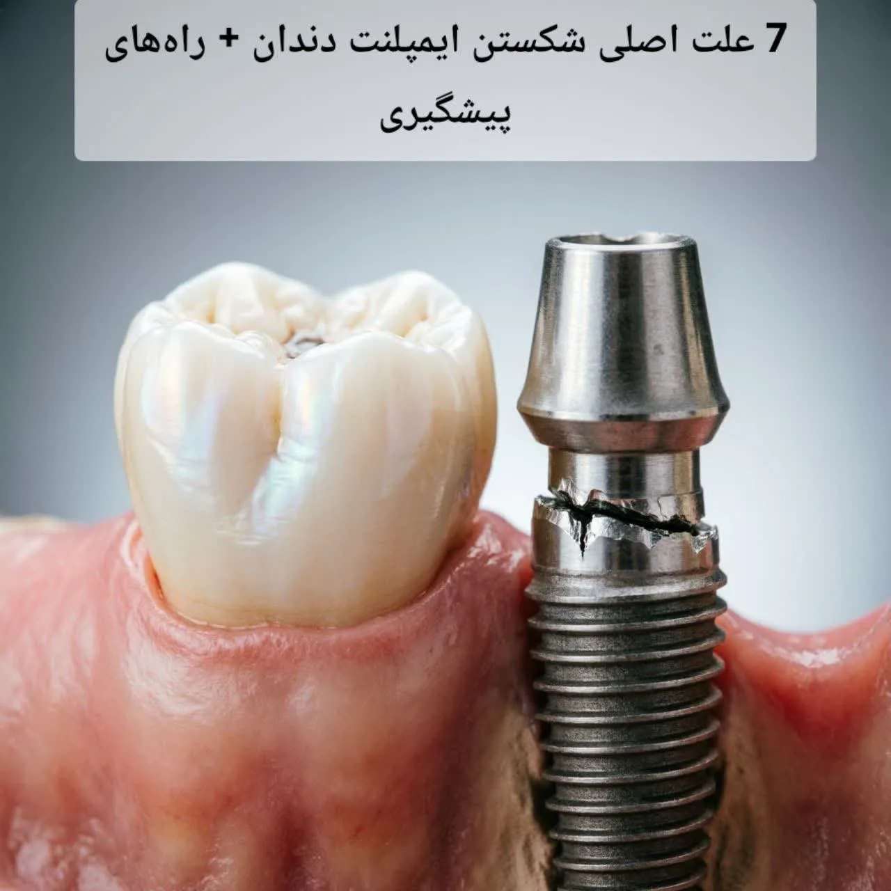 7 علت اصلی شکستن ایمپلنت دندان + راههای پیشگیری