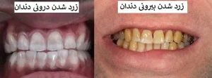 علت زرد شدن دندان ها؛ بررسی 7 دلیل اصلی که نمی‌دانستید