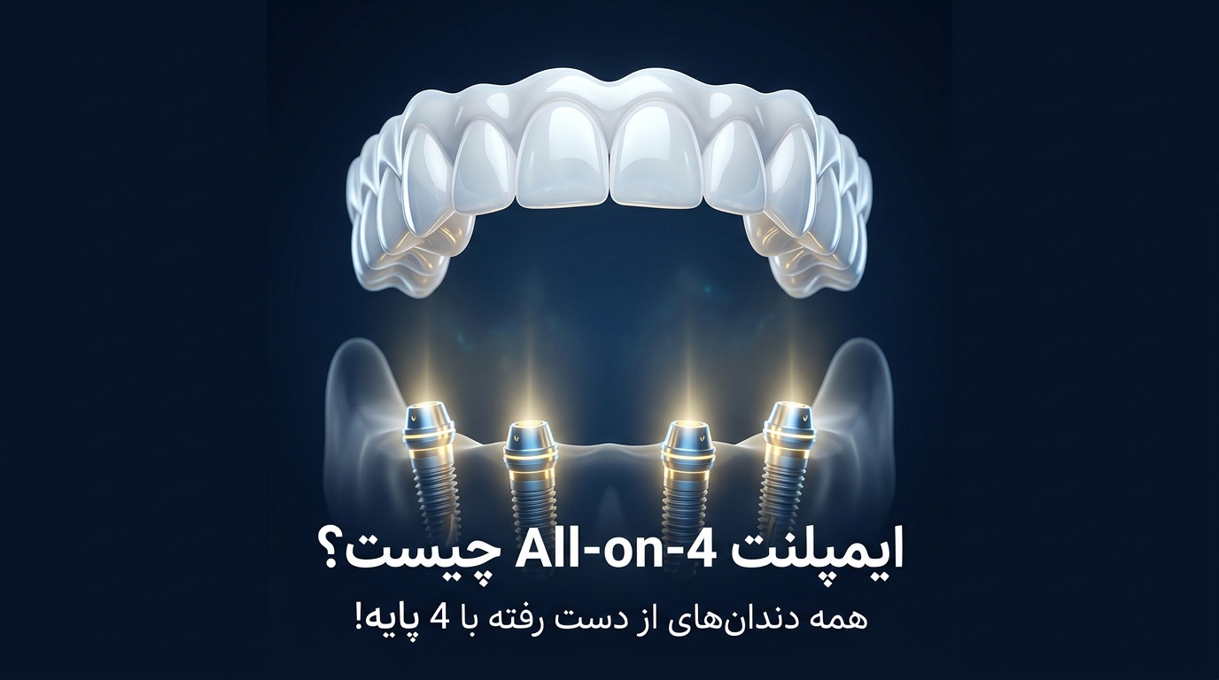 ایمپلنت All on 4