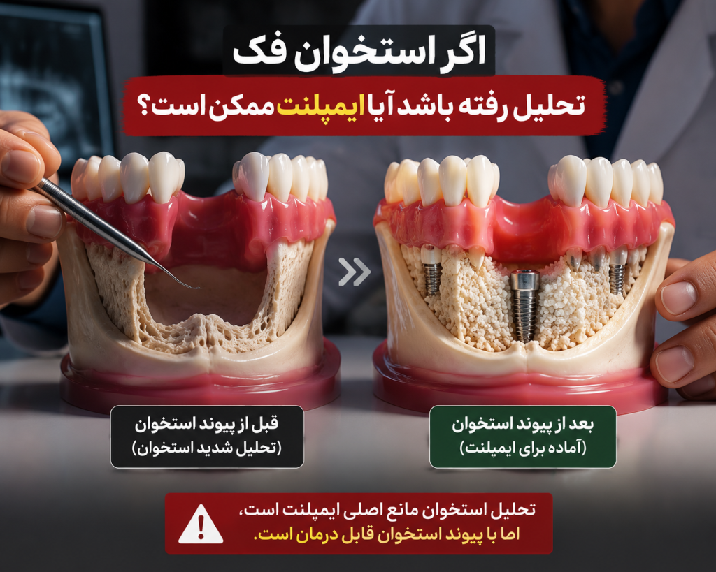ایمپلنت دندانهای جلویی؛ طبیعیترین روش جایگزینی دندان