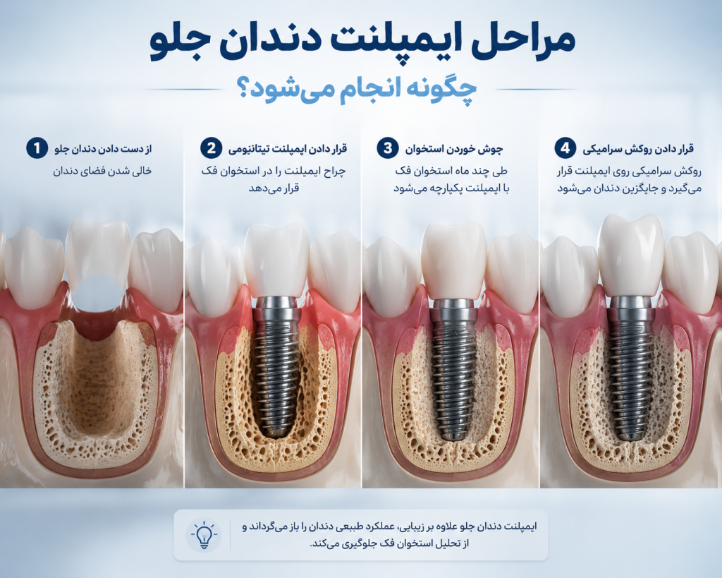 ایمپلنت دندانهای جلویی؛ طبیعیترین روش جایگزینی دندان