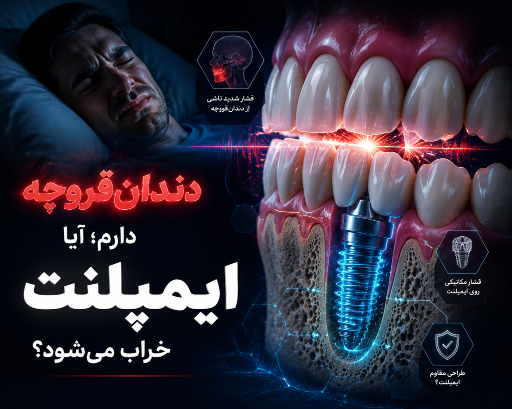 ایمپلنت در افراد با دندانقروچه؛ 7 نکته مهم قبل از ایمپلنت