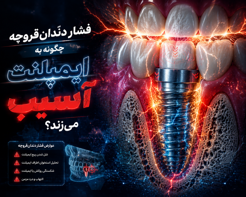 ایمپلنت در افراد با دندانقروچه؛ 7 نکته مهم قبل از ایمپلنت