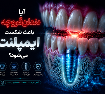 ایمپلنت در افراد با دندان‌قروچه؛ 7 نکته مهم قبل از ایمپلنت