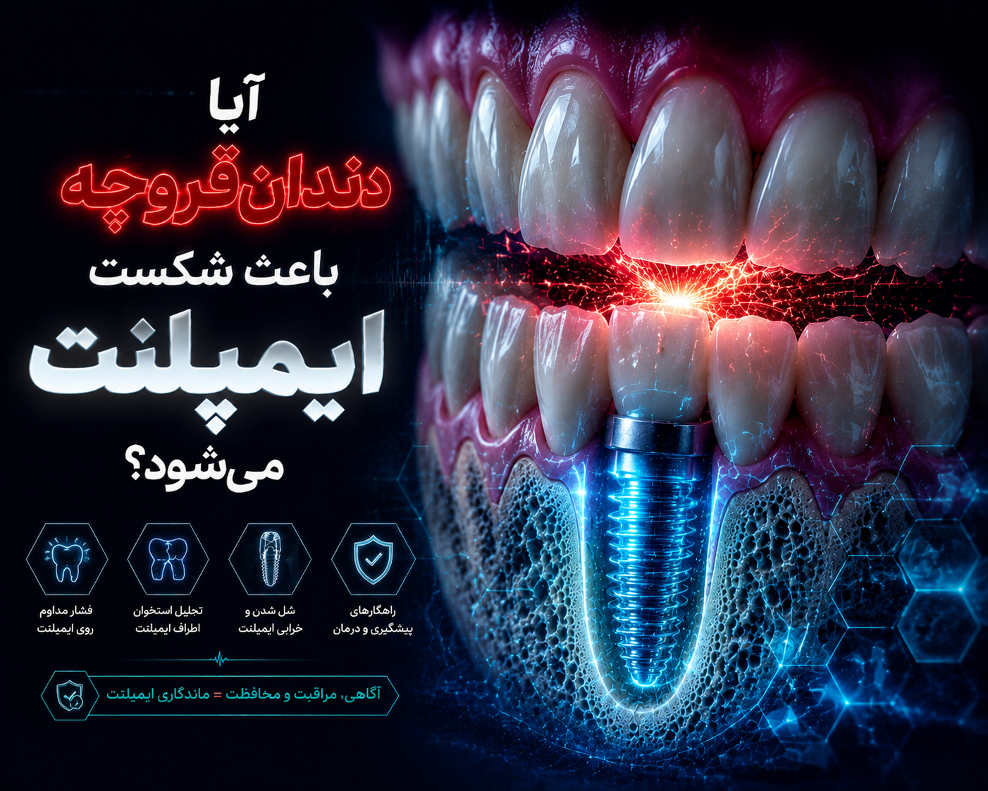 ایمپلنت در افراد با دندانقروچه؛ 7 نکته مهم قبل از ایمپلنت
