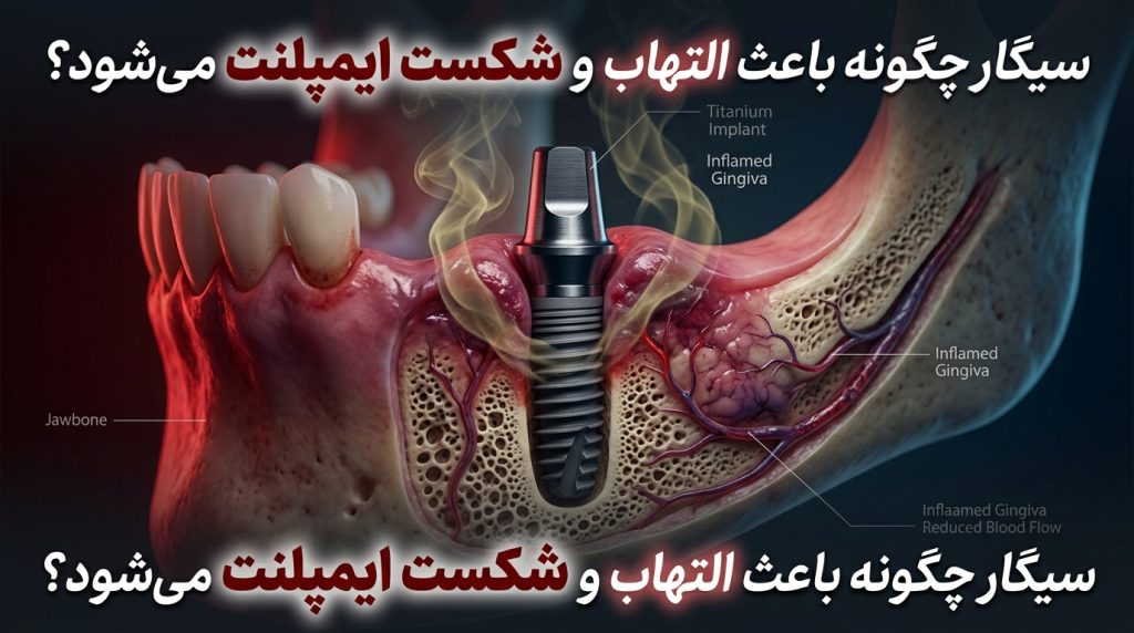 آیا افراد سیگاری میتوانند ایمپلنت دندان انجام دهند؟