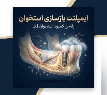 ایمپلنت بازسازی استخوان