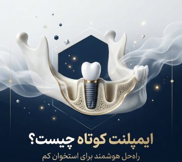 ایمپلنت کوتاه
