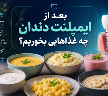 بعد از ایمپلنت دندان چه غذاهایی بخوریم؟