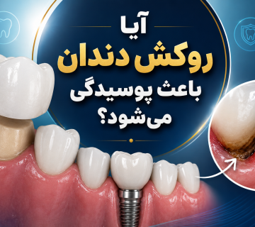 از کجا بفهمیم دندان زیر روکش پوسیده شده است؟