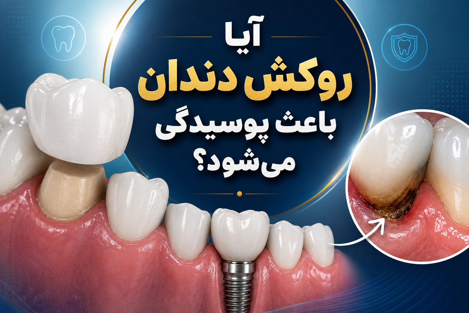 از کجا بفهمیم دندان زیر روکش پوسیده شده است؟