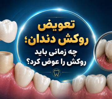 تعویض روکش دندان؛ چه زمانی باید روکش را عوض کرد؟