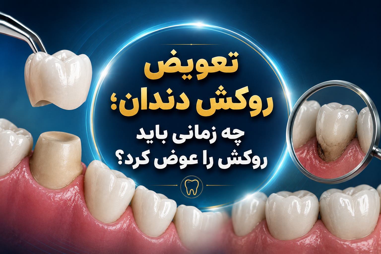 تعویض روکش دندان؛ چه زمانی باید روکش را عوض کرد؟